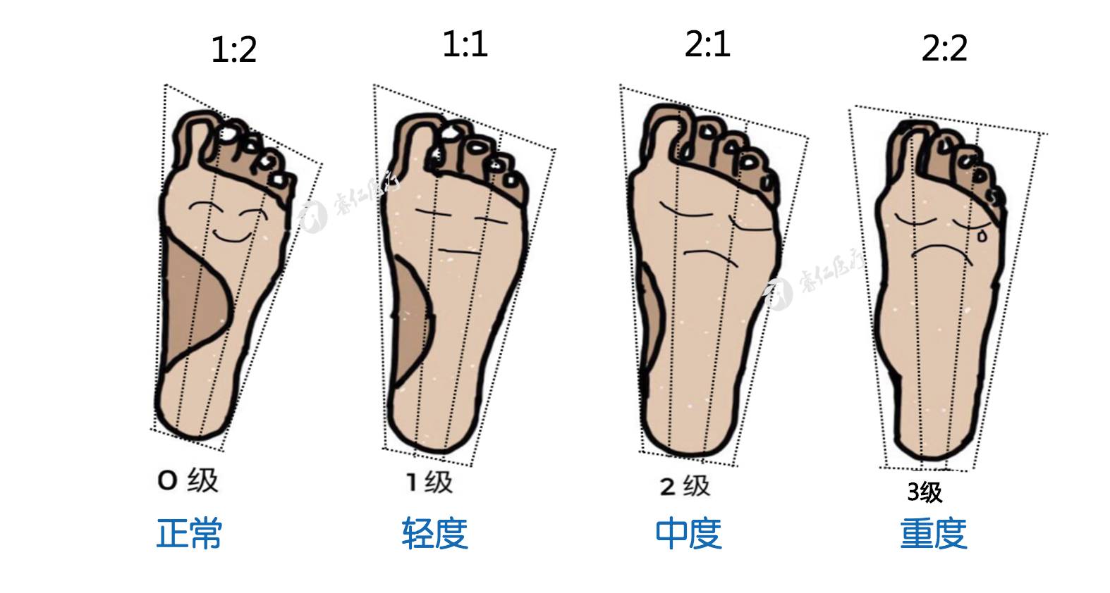 扁平足和正常足照片图片