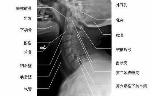 颈椎7节位置图片图片
