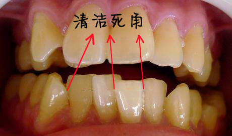 牙不齐危害如此多,您的牙齿还好吗?