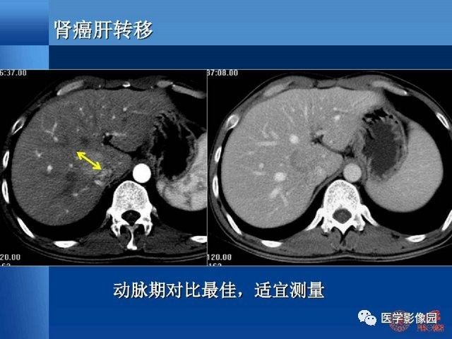 肝轉移癌ct檢查流程設計與優化探討學習丨影像天地