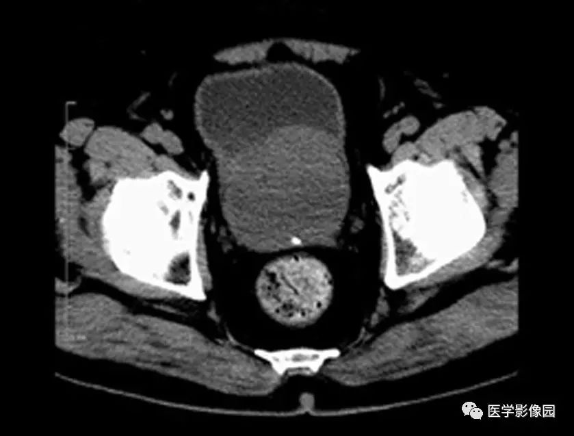 前列腺增生CT图片