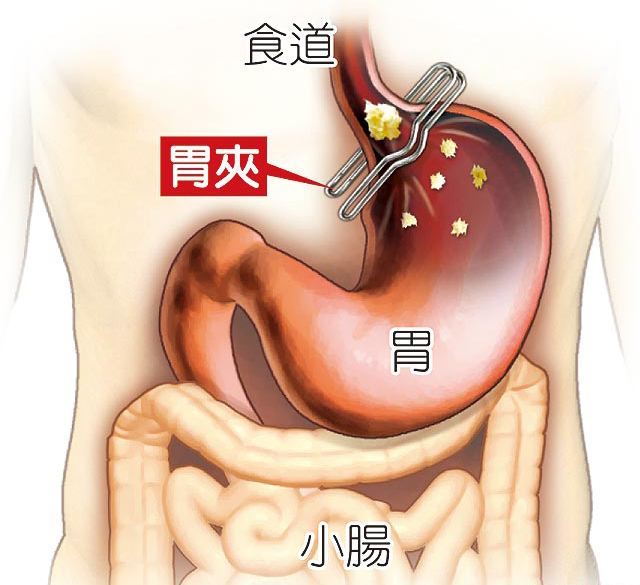 想减肥却控制不住嘴?把胃变小