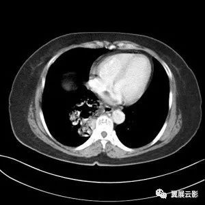 【影像病例】先天性肺发育畸形一例