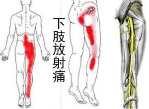 下肢放射痛:在腰椎間盤突出症初期,疼痛從臀部開始,逐漸放射到大腿