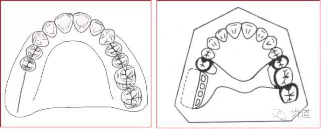 游离端缺失镶牙设计图图片