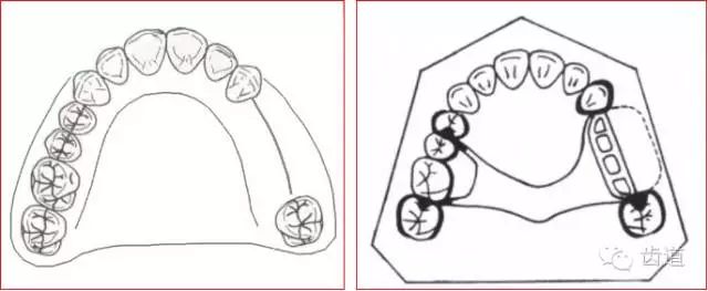 面支承型稳定设计:个别后牙缺失:线支承型多个后牙缺失:双侧设计连接