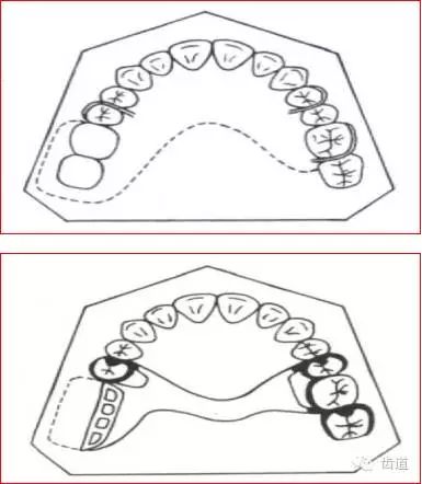 可摘局部义齿的肯氏(kennedy)分类及设计