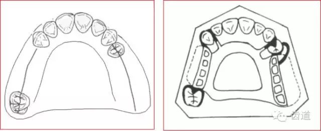 肯氏三类义齿设计图片图片