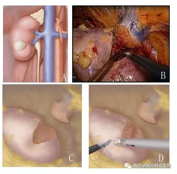 肾囊肿的手术图解图片