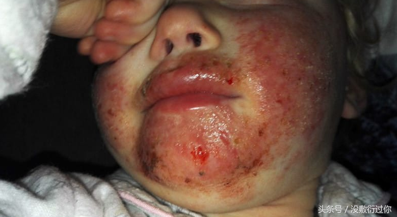 在她3岁生日那天,一位嘴唇上患有疱疹的亲人亲吻了她一口