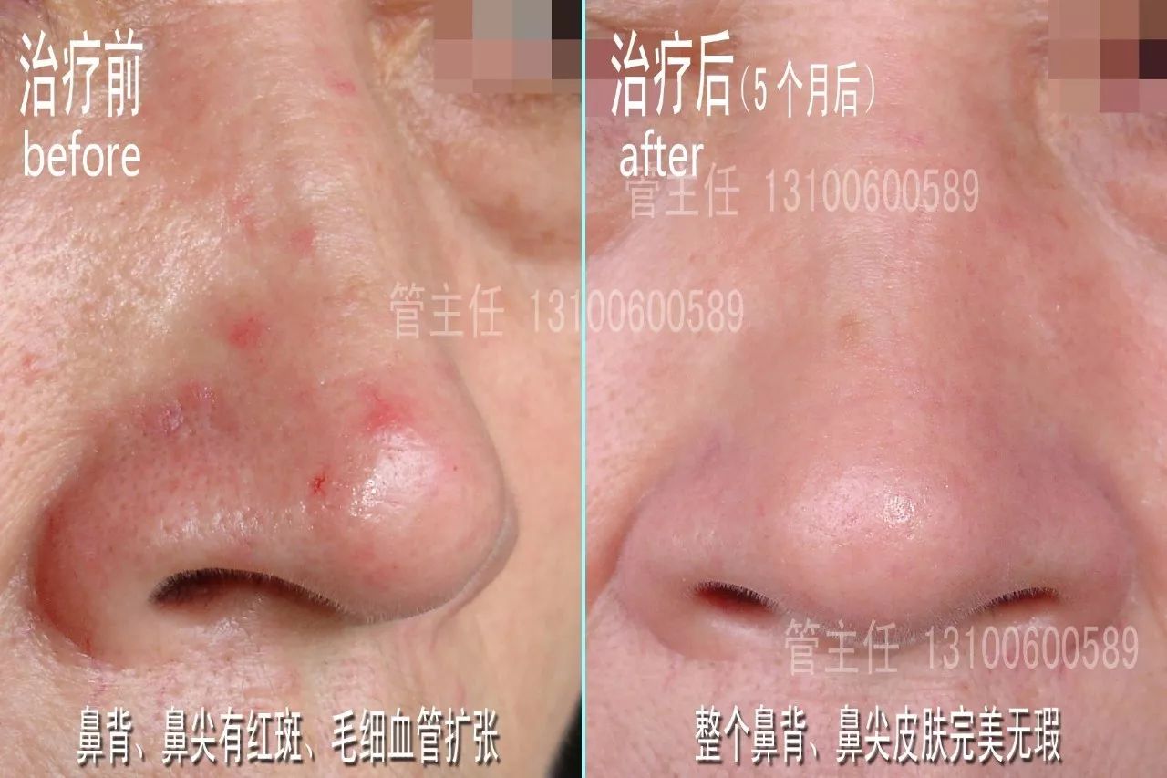 治療難點酒槽鼻(rosacea)是一種主要發生於面部中央