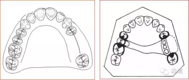 肯氏三类义齿设计图片图片