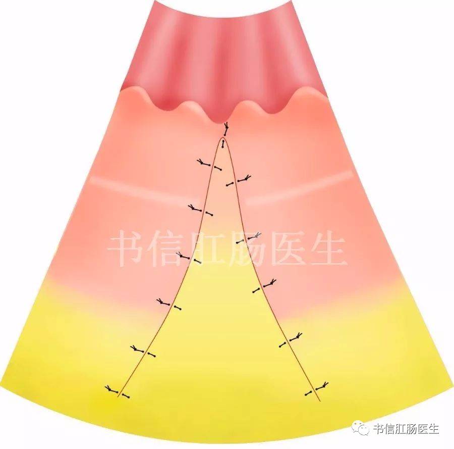 6 論縱切橫縫法縱切橫縫法是中醫外科教材推薦的一種肛裂術式,其適應