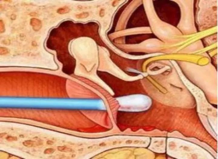 掏耳勺能碰到耳膜吗图片