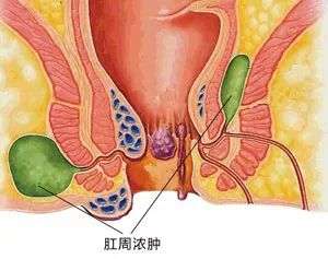 肛窦炎的症状有哪些图片