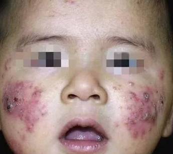 婴儿痤疮严重疤痕图片图片