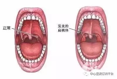 喉咙发炎怎么判断图片