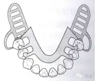 肯氏三类义齿设计图片图片