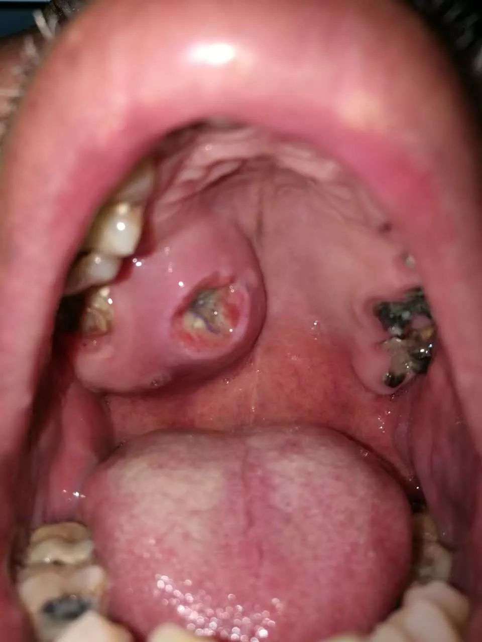 上颚口腔癌图片图片