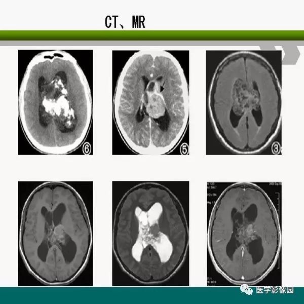 脑室内室管膜瘤的影像诊断及鉴别丨影像天地