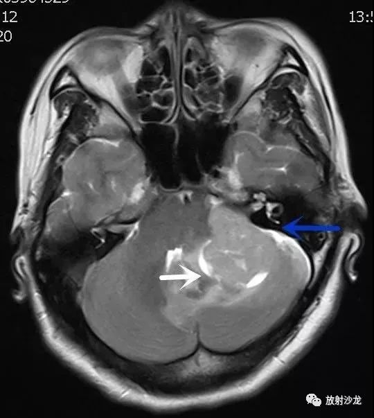 神經病例橋小腦角區實性佔位病變