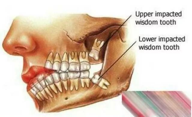 第三磨牙是什么位置图片