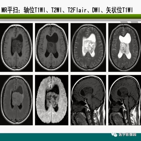 室间隔膜部瘤图片图片