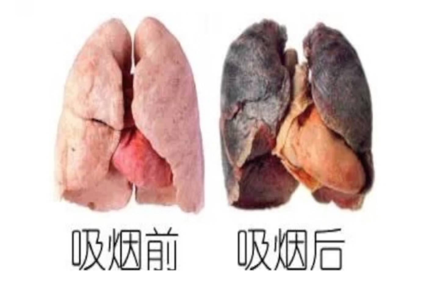 吸烟前后肺部对比照片图片