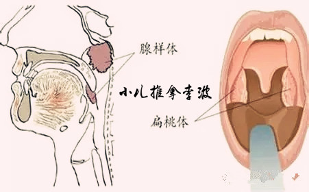 腺樣體也叫咽扁桃體,是咽部淋巴環的主要組成部分.