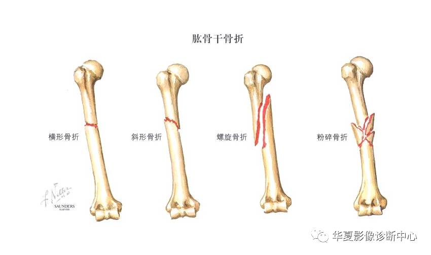 肱骨干骨折分型图片