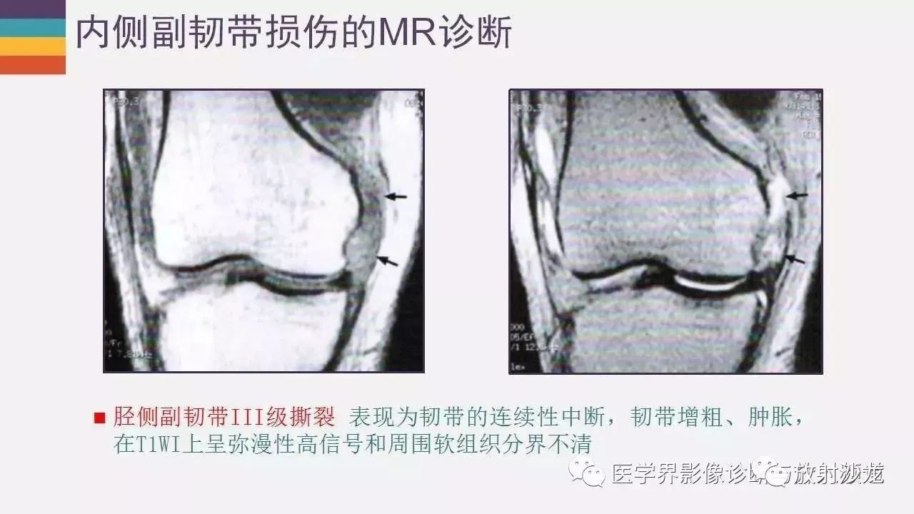内外侧副韧带MR图片