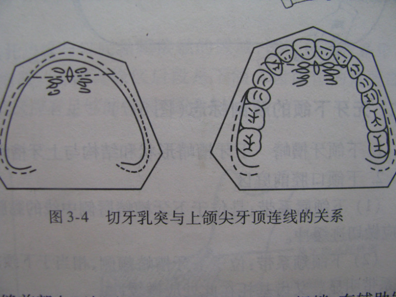 無牙頜活動義齒取模技巧