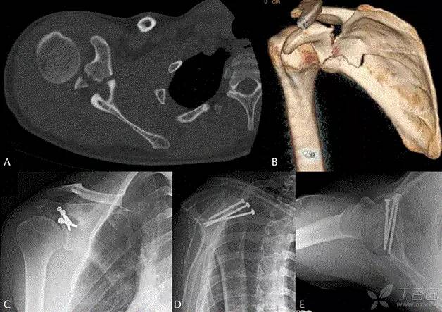 一文读懂 喙突骨折的手术技巧及经验