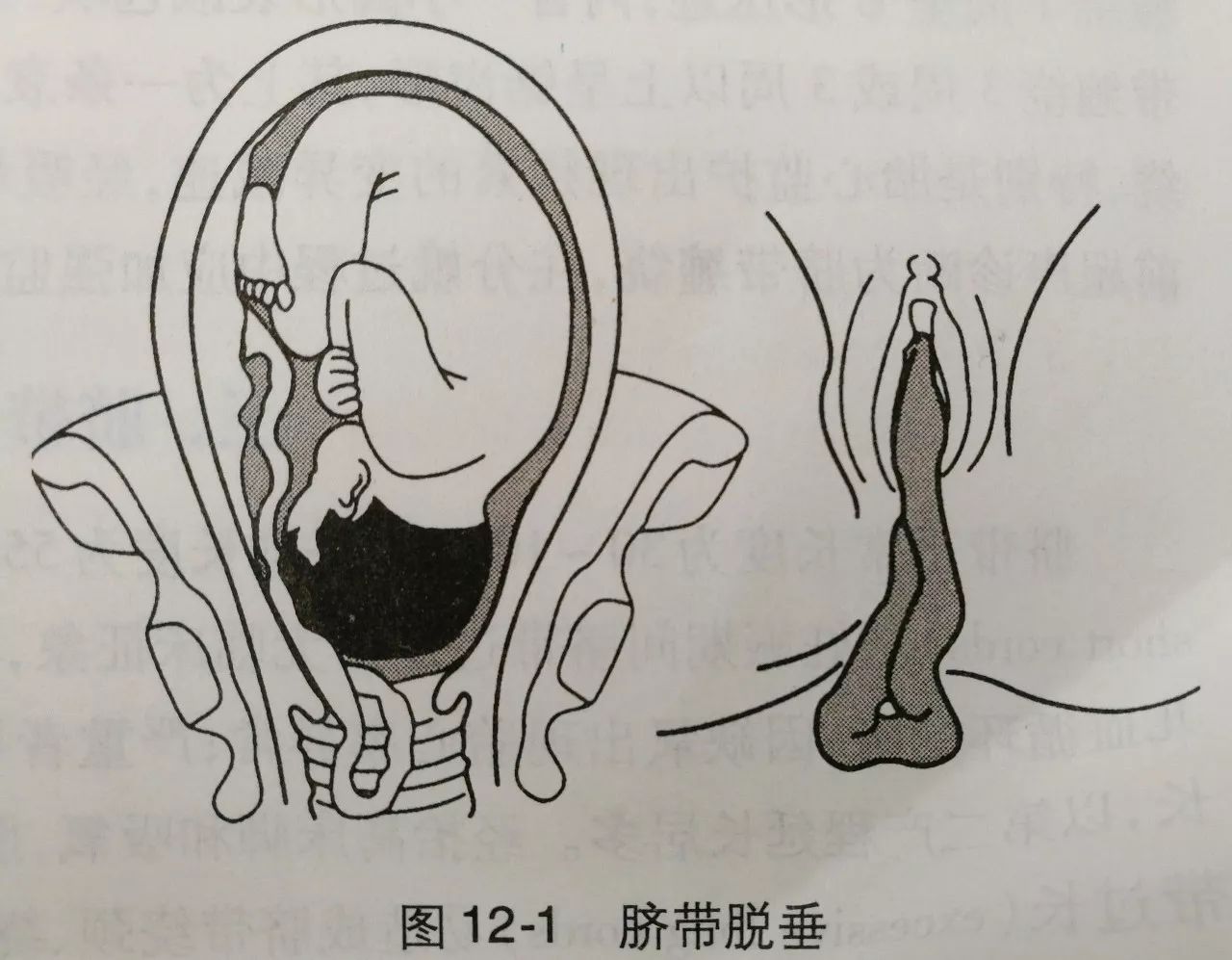 而脐带脱垂则是在胎膜破裂(俗称破水)后,脐带先于胎儿脱出宫颈口外