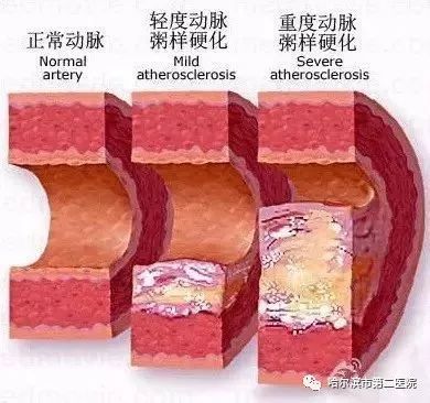 血液中过多的脂质沉积于受损的血管壁最终发展为粥样硬化斑块评估颈