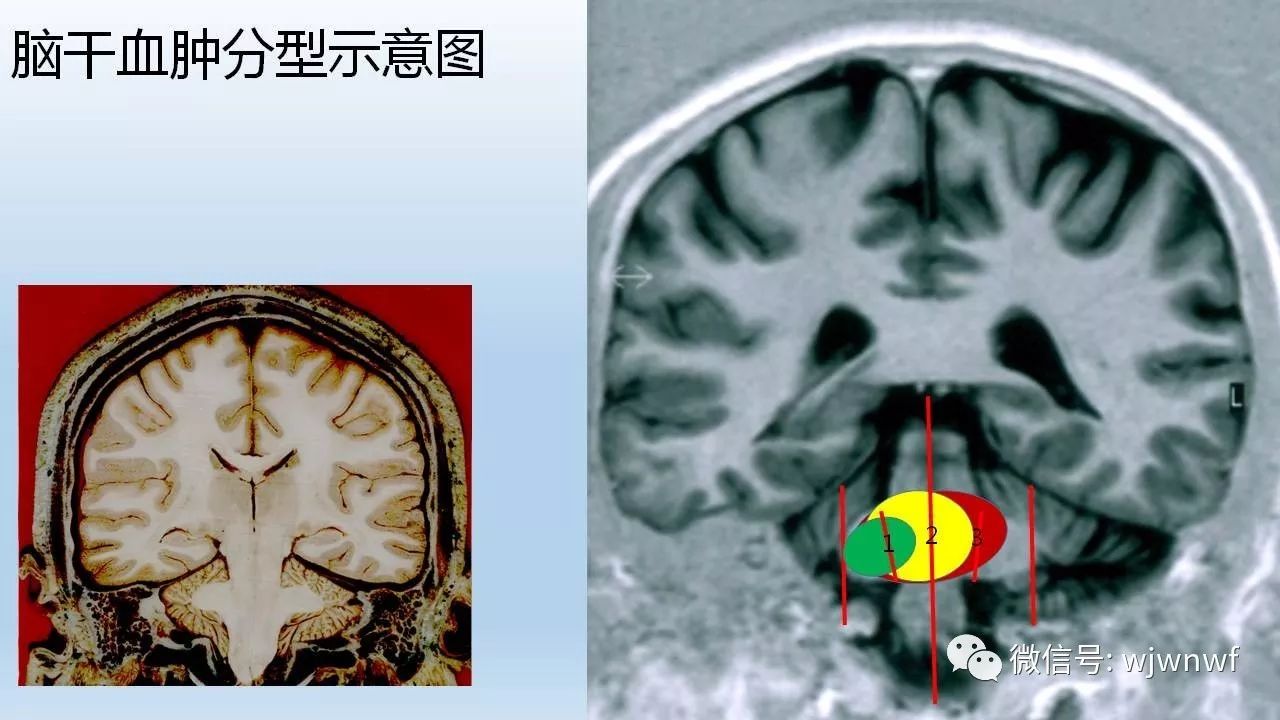 劉鳳強教授立體定向抽吸治療高血壓性腦幹出血