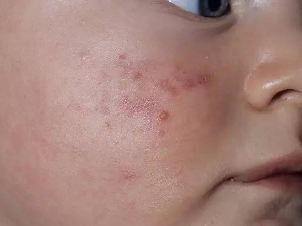 珍藏版宝宝最常见的皮疹的图片和护理方法