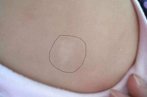 婴儿肚子上有白斑图片图片