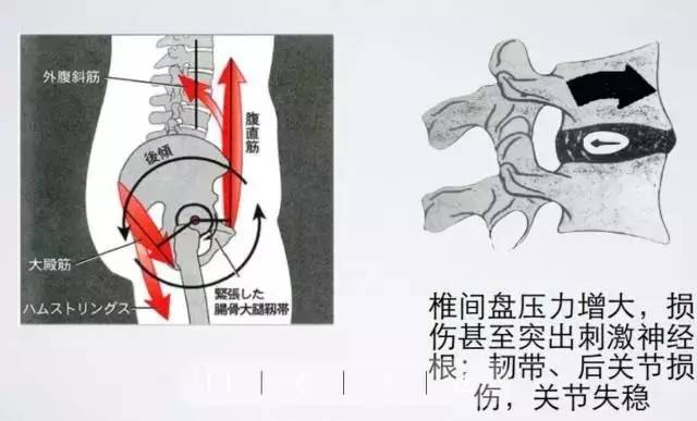 專家傾心解答燕飛動作不是所有腰椎間盤突出患者都能做