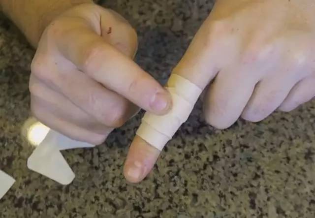南宁家长注意4岁女孩手指受了点伤最后竟要截肢只因