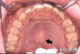 下颌舌侧骨隆突图片