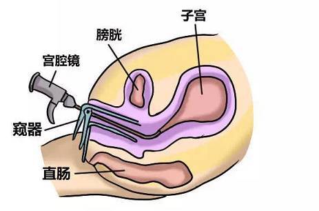 6,週期性腹痛:手術後一個月會出現突發性下腹部疼痛,肛門有墜脹感