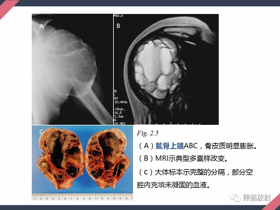 專題骨腫瘤樣病變1骨囊腫從病理到影像