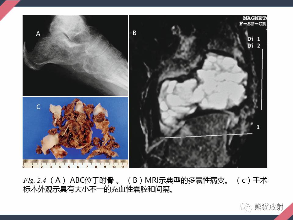 專題骨腫瘤樣病變1骨囊腫從病理到影像