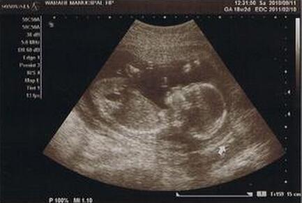 怀孕18周胎儿图片欣赏图片