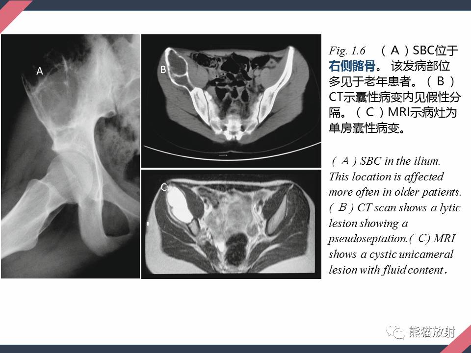 專題骨腫瘤樣病變1骨囊腫從病理到影像