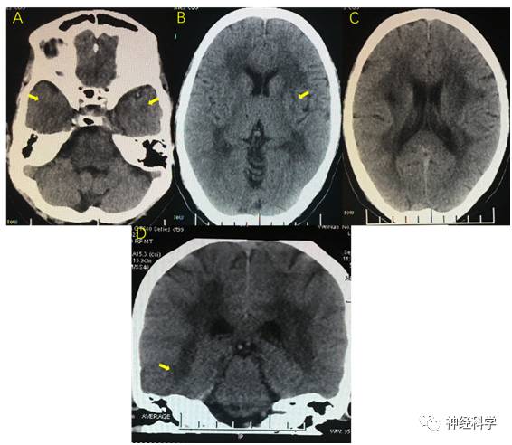 脑白质脱髓鞘图片