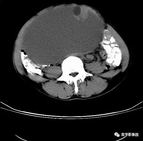 卵巢囊腺瘤CT图片