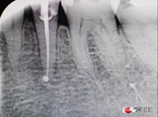 1例老年人頑固性慢性根尖周炎根管治療的感染控制