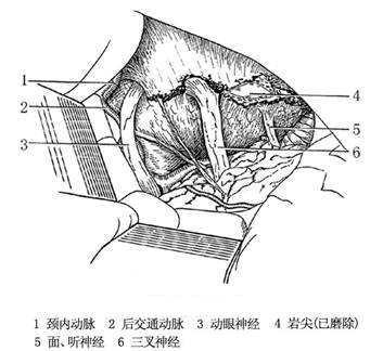 三叉神經meckel腔腦膜瘤